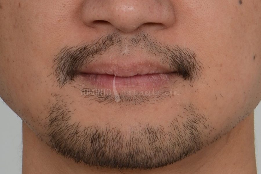 Beard Hair Transplant Toronto Patient 37