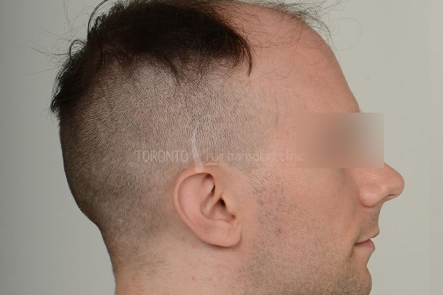 Hair Transplant Toronto Patient 36