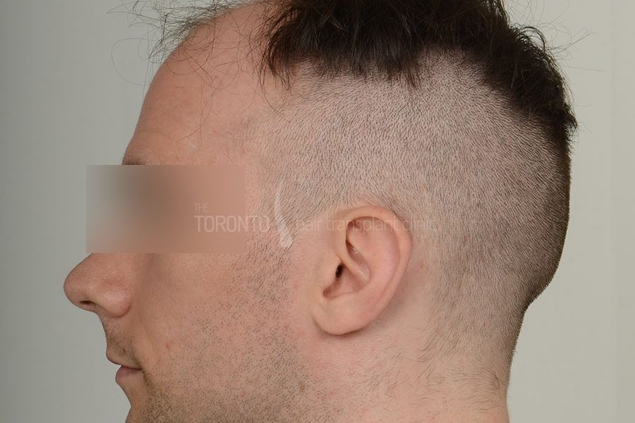 Hair Transplant Toronto Patient 36