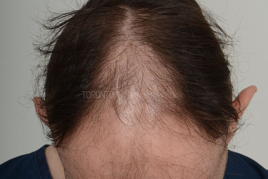 Hair Transplant Toronto Patient 36