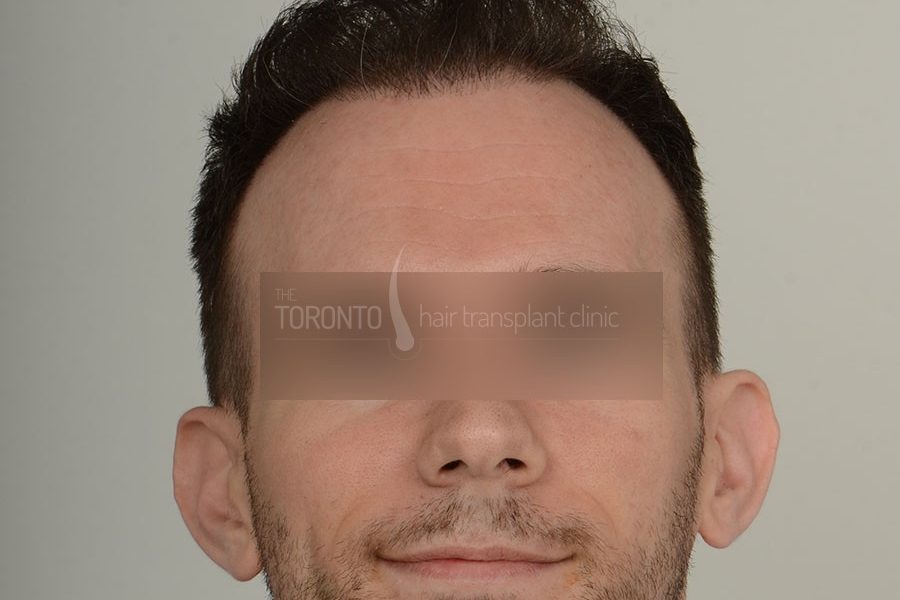 Hair Transplant Toronto Patient 36