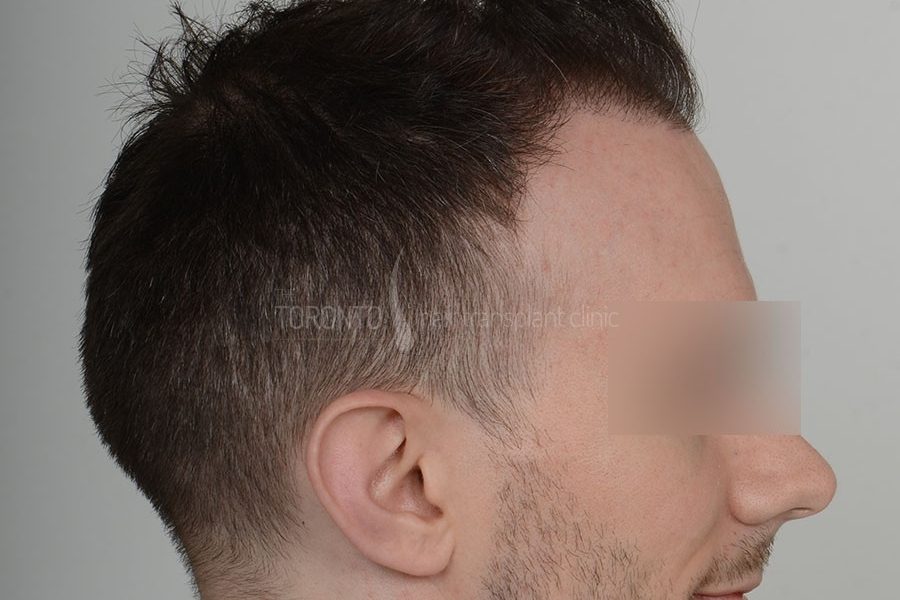 Hair Transplant Toronto Patient 36