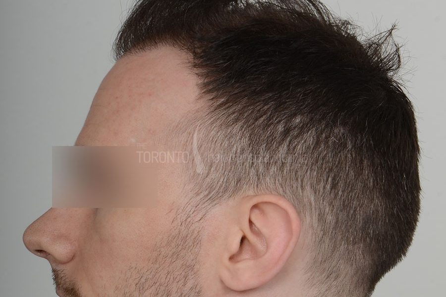 Hair Transplant Toronto Patient 36