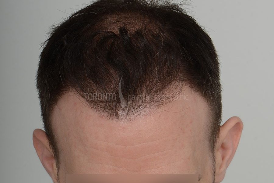 Hair Transplant Toronto Patient 36