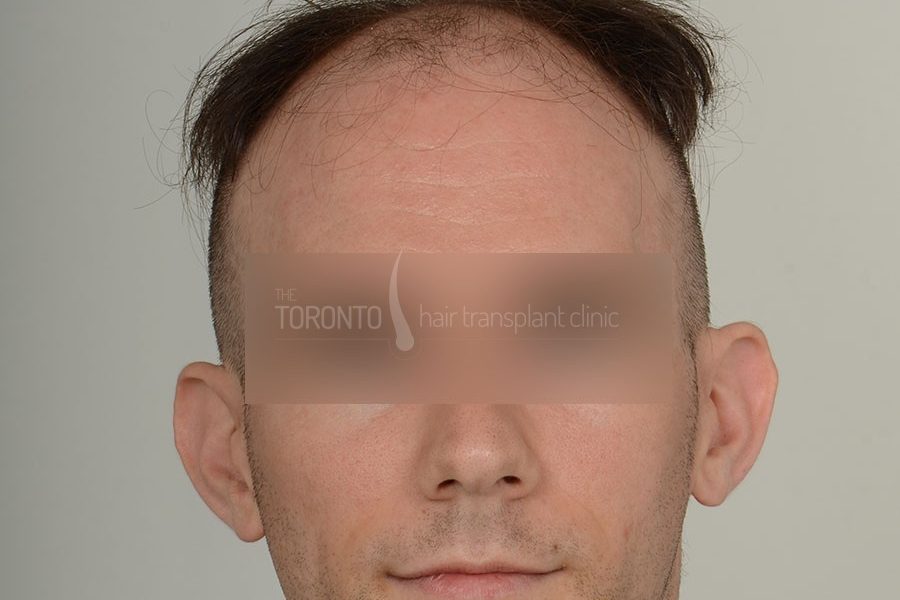 Hair Transplant Toronto Patient 36