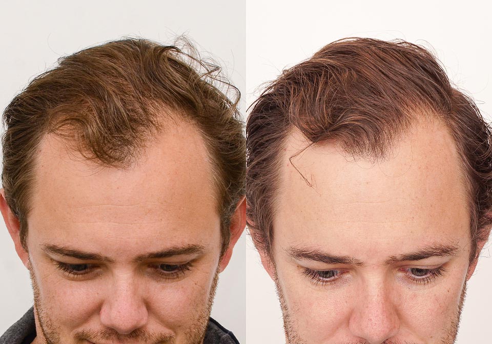 Shedding after an FUE Hair Transplant | Toronto Hair Transplant Clinic