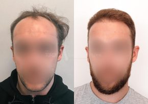 FUE-Hair-Transplant-Before-After-P25 (4)