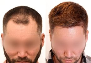 FUE-Hair-Transplant-Before-After-P28 (3)