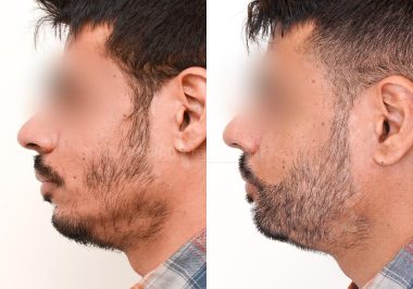 FUE-Hair-Transplant-Before-After-P29 (1)