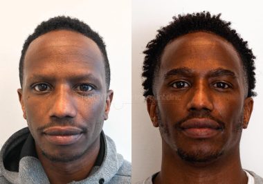 FUE-Hair-Transplant-Before-After-P39 (2)