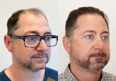 FUE-Hair-Transplant-Before-After-P49 (3)