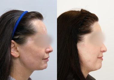 FUE-Hair-Transplant-Before-After-P56 (4)