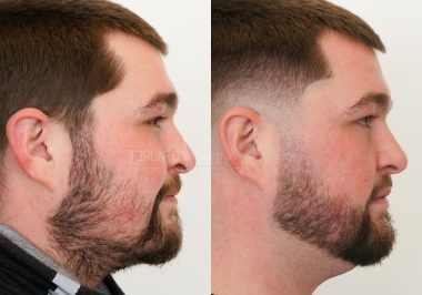 FUE-Hair-Transplant-Before-After-P60 (4)