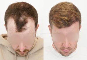 FUE Toronto: 3 Tips for Regular Guys to Get Celebrity Hair