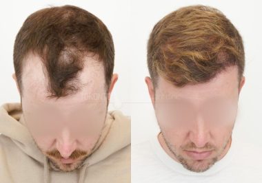 FUE-Hair-Transplant-Before-After-P74 (2)