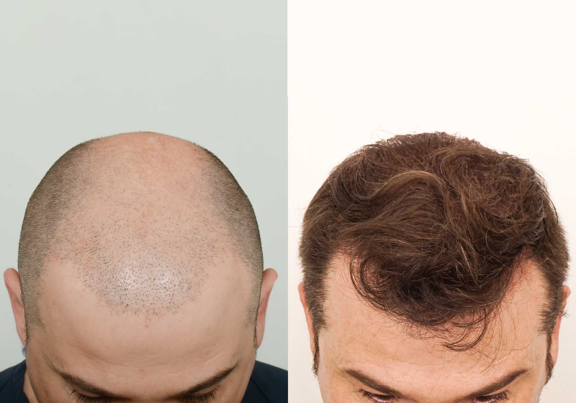The Toronto Hair Transplant Clinic FUE Toronto • NeoGraft • SmartGraft