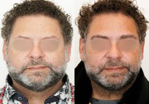 FUE Eyebrow Transplant Before & After