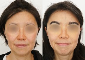 FUE-Eyebrow-Transplant-Before-After-P4 (1)