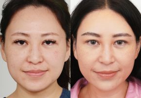 FUE-Eyebrow-Transplant-Before-After-P5