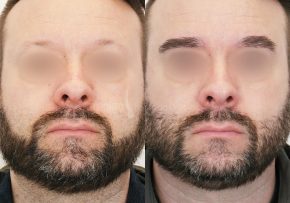 FUE-Eyebrow-Transplant-Before-After-P6 (3)