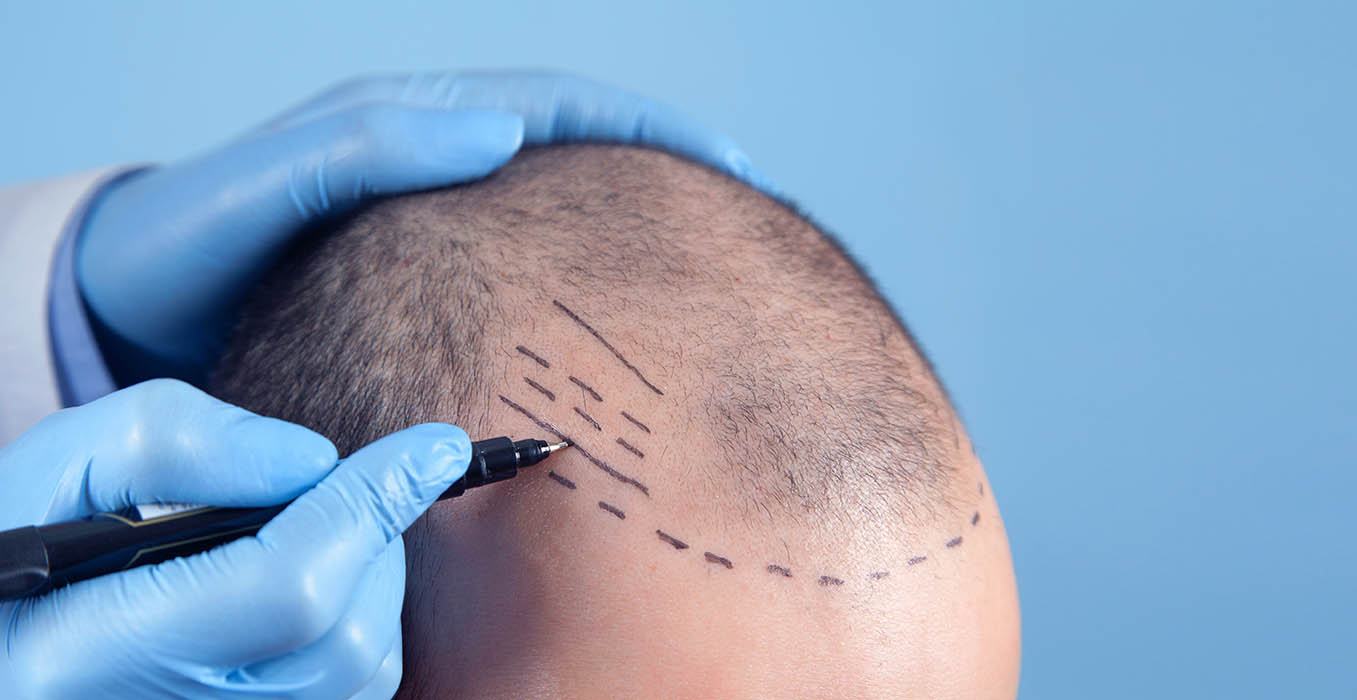 Hair Transplant Boston, MA Hair Transplant Boston, MA
