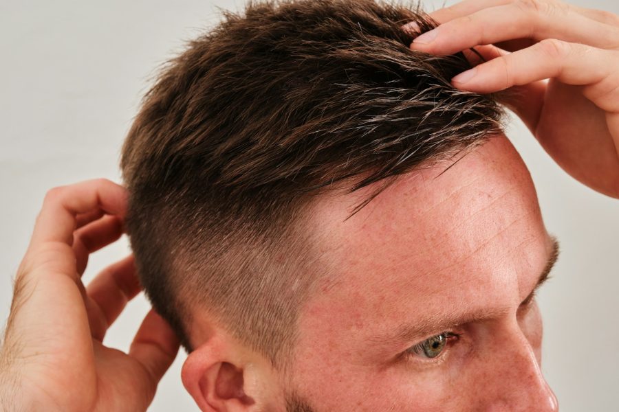 Understanding Male Pattern Baldness Treatment Options
