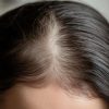 Living with Thinning Hair: When to Consider Hair Replacement Services