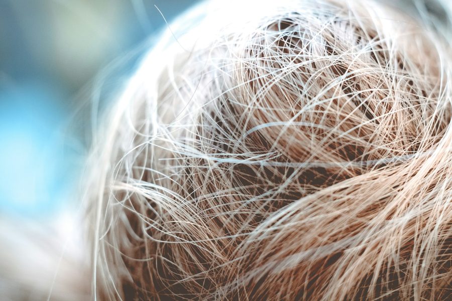 Norwood vs. Diffuse Thinning: Donor Strategy, Hairline Design, Graft Budgeting