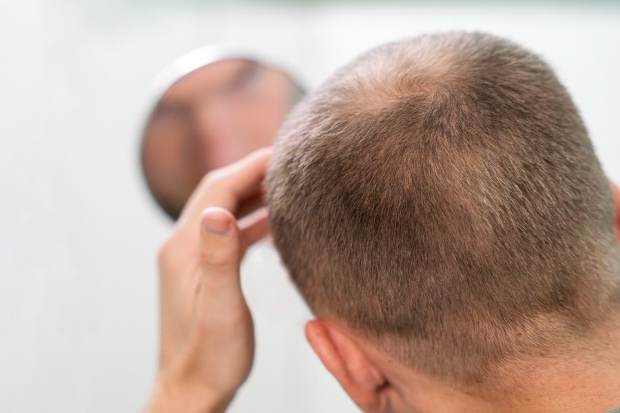 Can Hair Regrowth Resume After Telogen Effluvium?