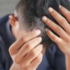 Autumn Shedding and PRP Therapy for Hair Loss